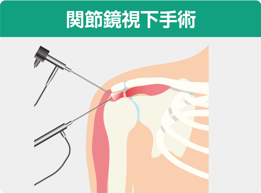 肩の手術がうまくいかなかったかどうかはどうやってわかりますか?