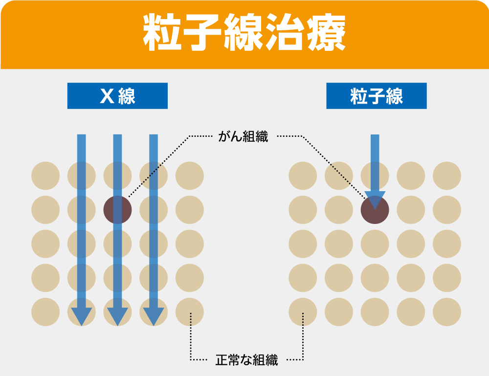 名医を探せ!! がん放射線治療